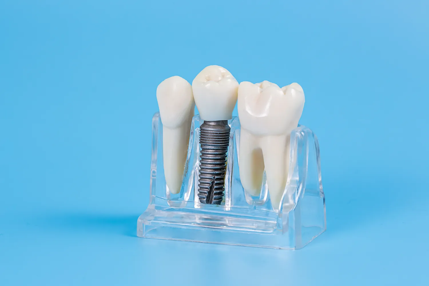 Dentysta Warszawa implanty