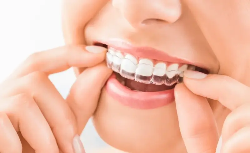 Ile kosztuje Invisalign w Polsce?