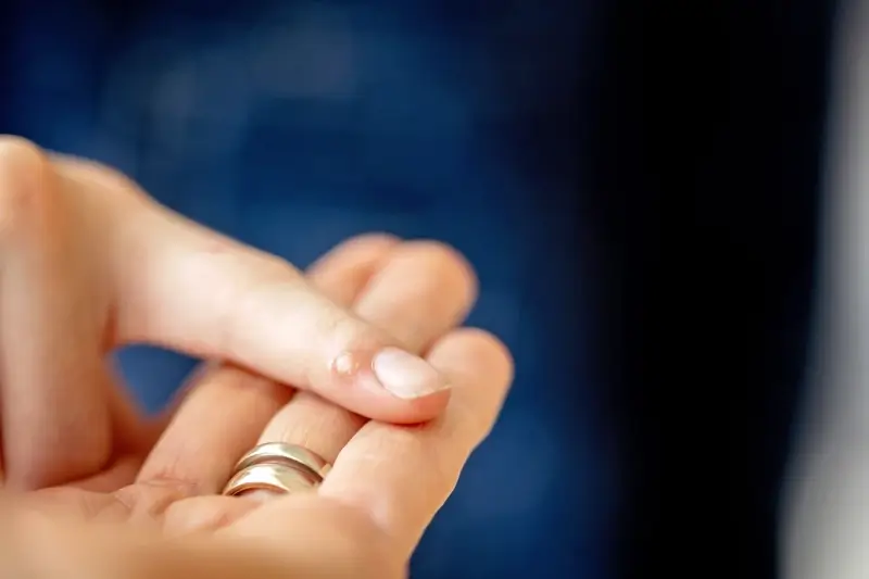 Jak pozbyć się kurzajki na stopie?