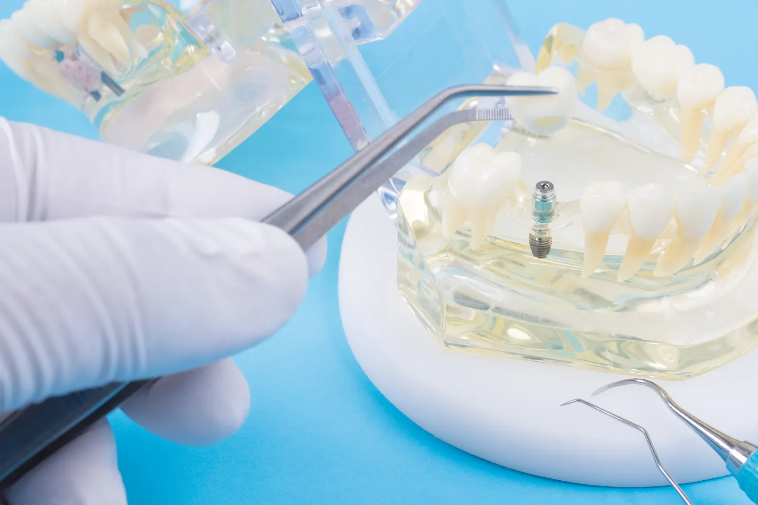 Implanty zębowe - poznaj ich zalety oraz wady