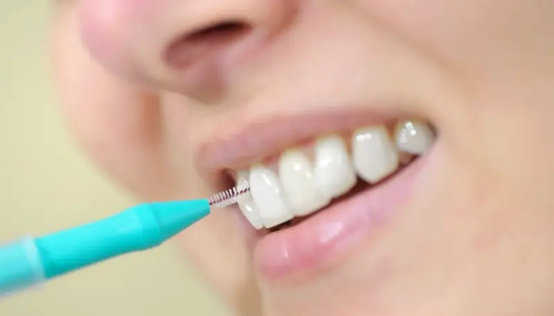 Najlepsze nakładki ortodontyczne Szczecin