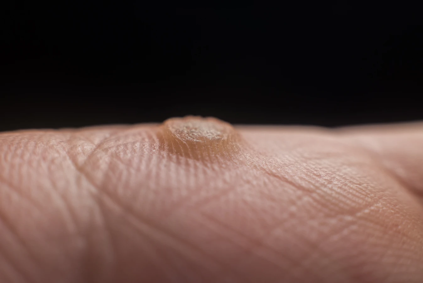 Czy kurzajką można się zarazić?