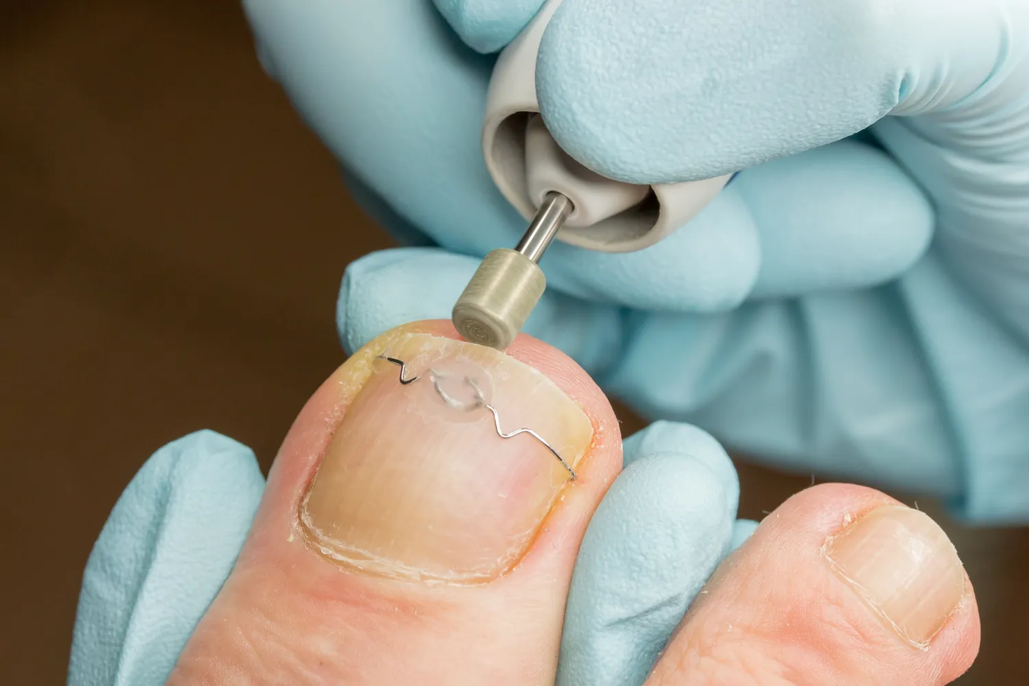 Najczęściej pojawiające się problemy podologiczne